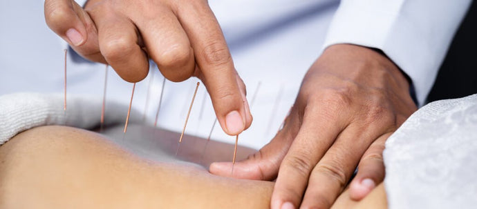 Discover the Benefits of Acupuncture: A Modern Approach to Timeless Healing